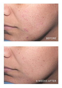 ACNE CONTROL SYSTEM