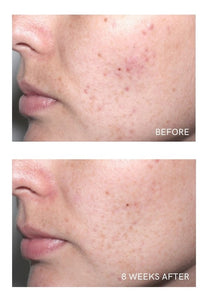 ACNE CONTROL SYSTEM