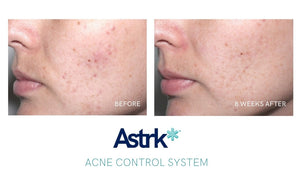 ACNE CONTROL SYSTEM